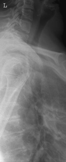 Profil (lateral) radiografie evidențiind