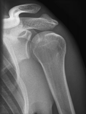 Antero-posterior (AP) Oblică radiografie de cap de Humerus evidențiind