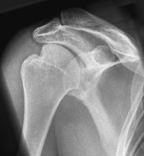 suspiciune de fractură affecting inferior rim (Bankart lesion) ca well ca differ-