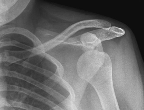 Antero-posterior (AP) Umăr (Profil (lateral) Humerus incidență) evidențiind Hill-Sachs