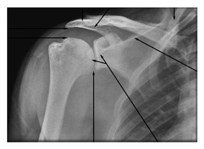 • subacromial spații articulare trebuie să fie vizualizat above the