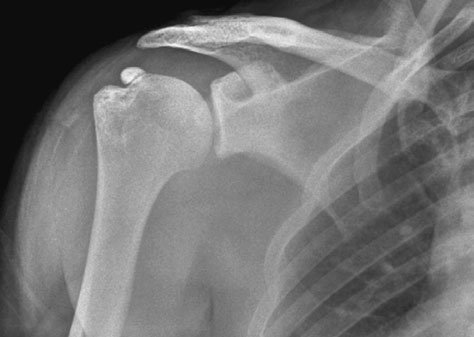Antero-posterior (AP) radiografie de Umăr outlet evidențiind normal undersurface