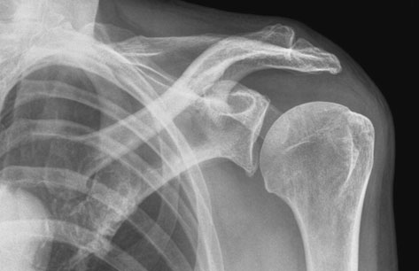 de acromion (incidental calcificări patologice de supraspinatus tendon)