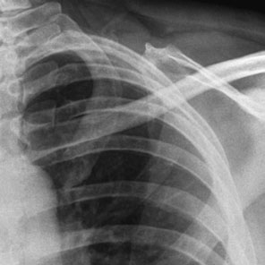 Collimated Antero-posterior (AP) radiografie de stâng first și second Coaste (Grilaj Costal)