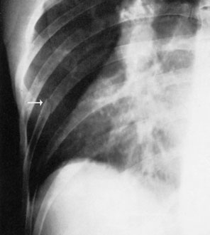 radiographic contrast astfel încât Coaste (Grilaj Costal) sunt visualized adequately