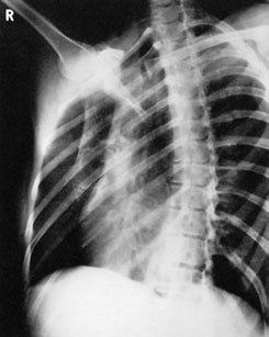 radiografie de drept lower Coaste (Grilaj Costal) evidențiind acute suspiciune de fractură