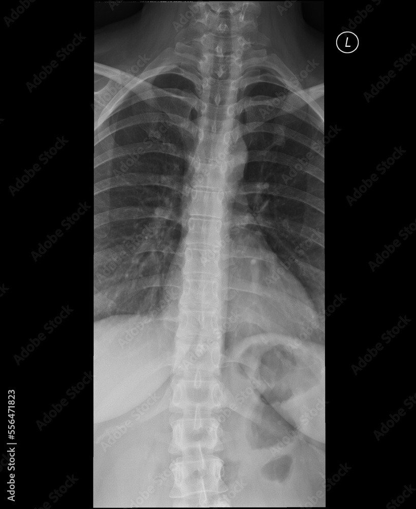 Radiografie coloană toracală față
